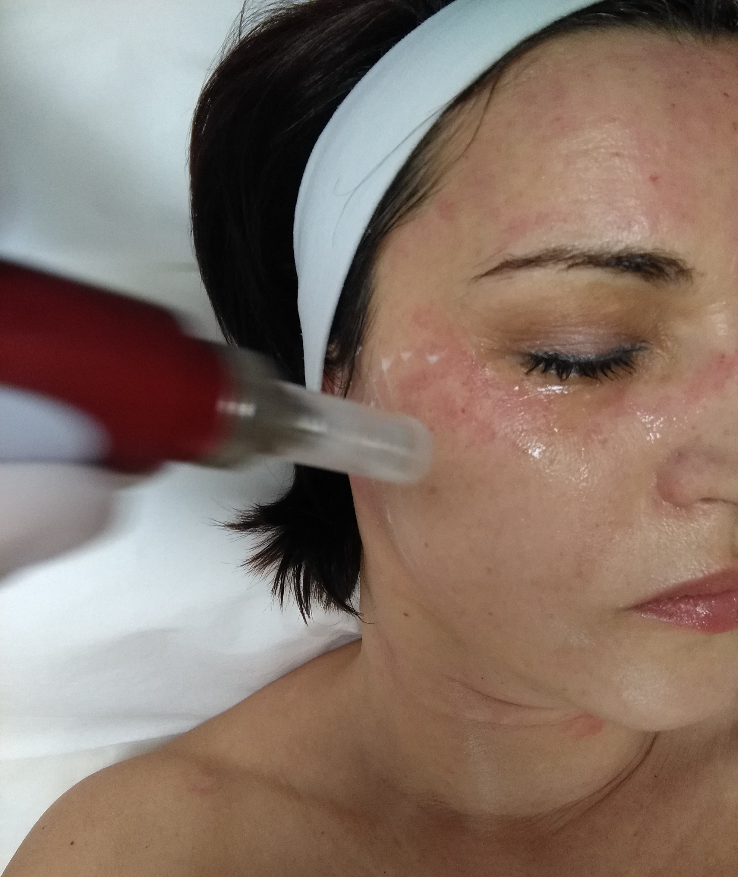 dermaroller, dermapen, mezoterápia, stria kezelés, akne heg kezelés.bőrfiatalítás, arcfiatalítás, ránckezelés