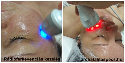 rádióferkvenciás arc és testkezelés, ránckezelés, zsírcsökkentés, bőrfiatalíltás, Aqualyx